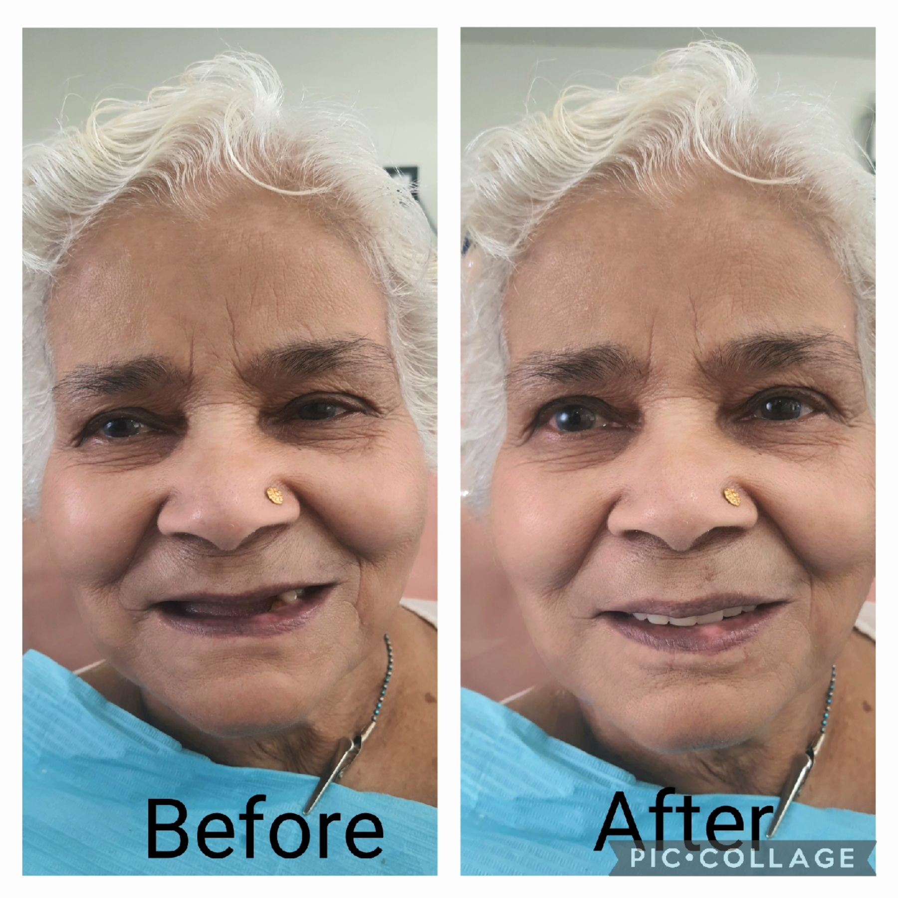 complete denture in Greater Noida